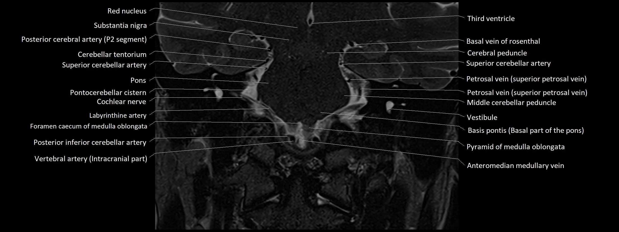 Anatomy of cerebellum coronal cross sectional 3T image 1.webp